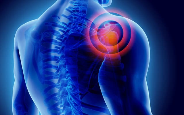 Illustration af skulder og smerteområde