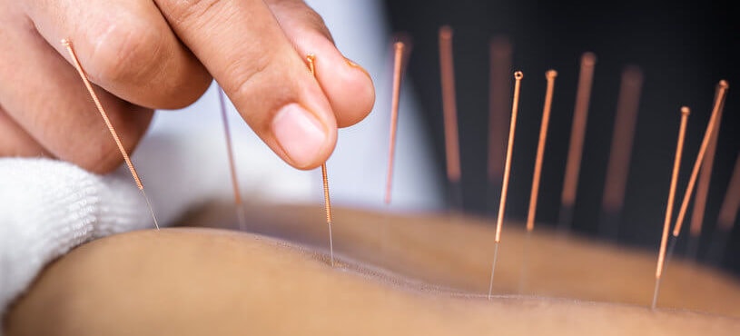 Akupunktur behandling